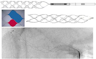 Endovascular treatment of acute ischemic stroke with a fully radiopaque retriever: A randomized controlled trial